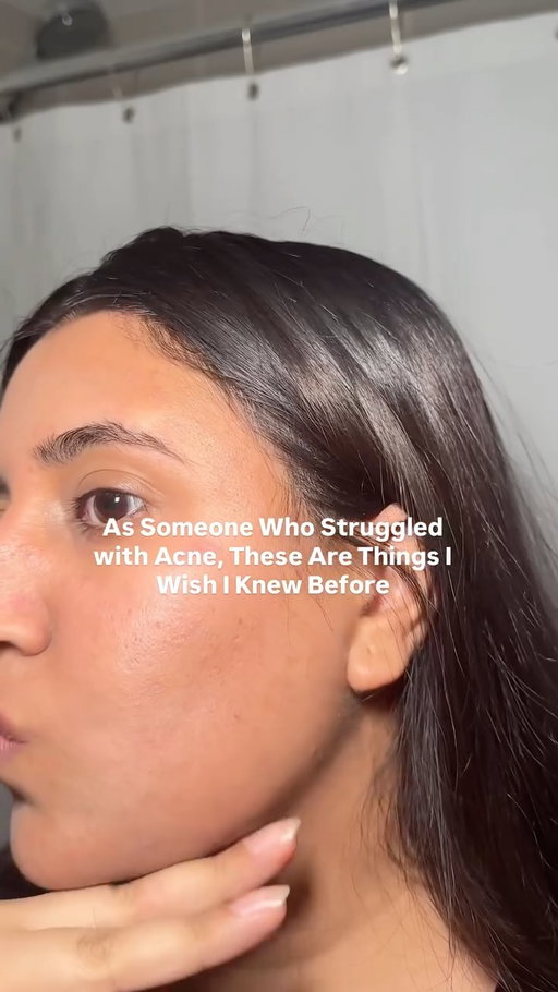 If you are struggling with acne read this 👇

Things I wish I knew before struggling with acne for years 🥲

Not all acne is actually acne, sometimes it’s fungal acne, and treating it like regular acne can make it worse

Oil cleansers were triggering my skin more than helping it

 Switching to fungal acne-safe products made a bigger difference than buying more skincare

Keeping my routine simple helped my skin heal faster• you don’t need a 10 step routine

Washing my face with just water in the morning actually helped calm my skin

Over Exfoliating damaged my skin barrier and caused more breakouts

Less products = less irritation sometimes

I genuinely wish I learned this sooner because my skin improved so much faster once I simplified everything 🤍

#acne #fungalacne