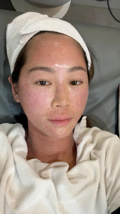 @rejurancosmetics making salmon DNA less painful! 🙏🏽#rejuran #pdrn #cpdrn #primeday