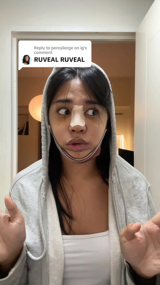 Face reveal! Two weeks post op! @ruthlynmd  @rpsaesthetics  made it happen :))
