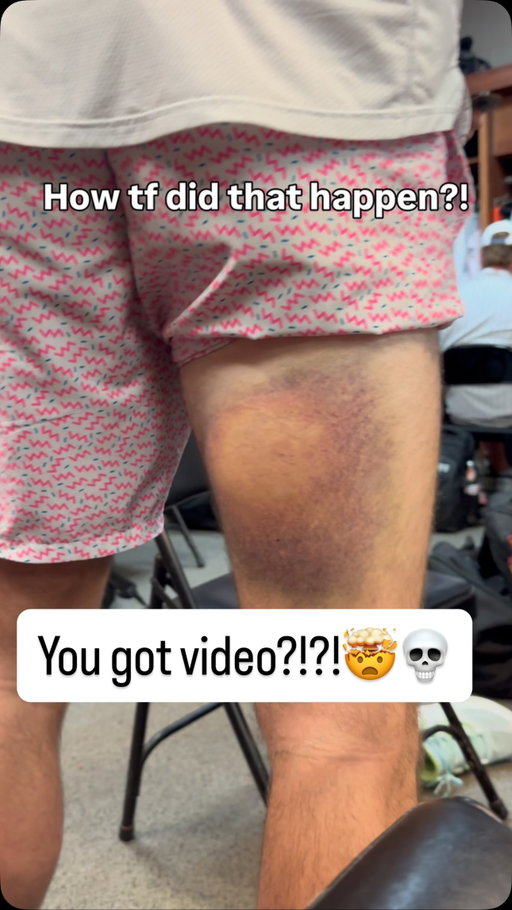 Just a human target 🎯

#bullseye #bruise #bananaball #ouch #hurt