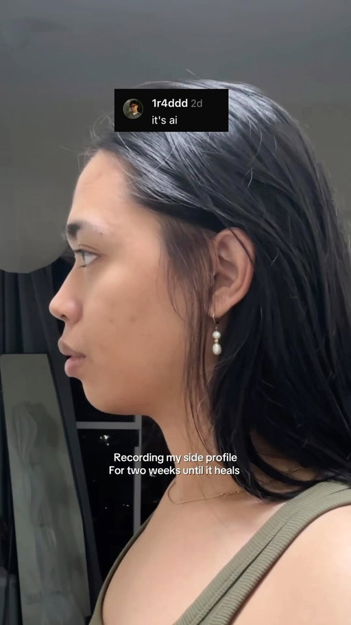 Good thing i documented 🤩  PS. It’s gonna take at least a year but we see the vision already :)) thanks to doc @ruthlynmd @rpsaesthetics