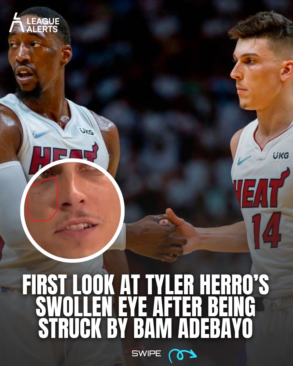 Tyler Herro was spotted at Summer League with visible swelling on his eye and cheek, the first look at the aftermath of Friday’s altercation with Bam Adebayo in Las Vegas.