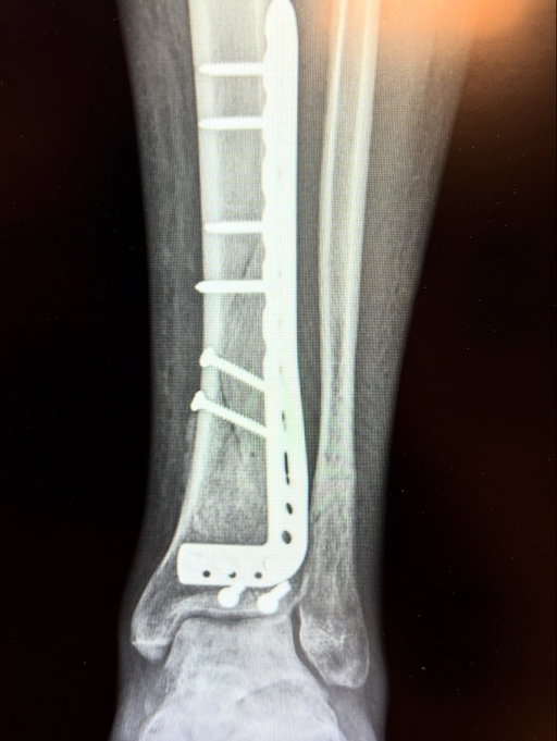 Them bones are growing back together. Wild. See you on tour!!