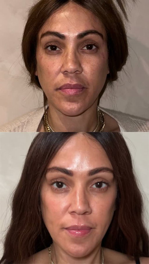Melasma is one of the most common skin concerns I get asked about, and while there's no quick fix, consistency really does make a difference.⁠
⁠
One of the treatment combinations we offer at Shani Darden Studio for the right candidates is microchanneling paired with the Dr. Sunder Future So Bright Pads. Together, they help improve the appearance of discoloration and uneven skin tone while supporting a brighter, more even-looking complexion over time.⁠
⁠
And of course, daily SPF is essential to help protect your skin and maintain your results.⁠
⁠
Book a consultation at Shani Darden Studio to see if this treatment is right for you. 🤍 You can purchase the pads at my studio or at the link in my bio.
