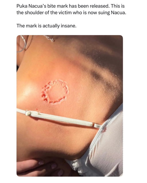 🚨 PUKA NACUA WHAT IS THIS? 

Recent attention on the case came after a new color photo of the alleged bite mark was released. According to the woman and her attorney, the image shows a clear circular impression of teeth on her shoulder/scapula area, and they argue it demonstrates the injury was far more serious than “horseplay.” Her attorney also says the wound required medical treatment, including a tetanus shot, and has caused ongoing emotional distress. 

Puka Nacua’s attorney has acknowledged that a bite occurred but maintains it happened during mutual horseplay on New Year’s Eve and disputes the significance of the injury. More recently, his attorney has also questioned whether the newly released color photo accurately reflects the alleged bite mark, suggesting its authenticity and interpretation could be challenged in court. 

The legal case is still ongoing. Criminally, the matter is currently on track for a pre-filing diversion program rather than formal misdemeanor charges, while the separate civil lawsuit alleging assault and battery, gender violence, and negligence continues. Depending on how the case is resolved, the NFL could still review it under its Personal Conduct Policy.