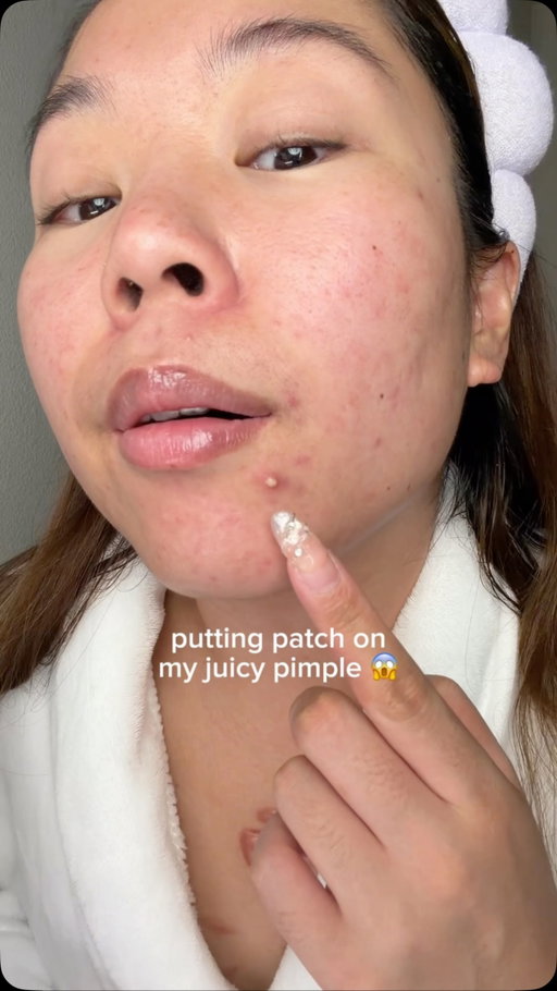 anyone else breakout every time their period comes 🫠 #acne #skincare #pimplepatch @rodanandfields @easyderm.official @purito_official @tirtir_global @olehenriksen