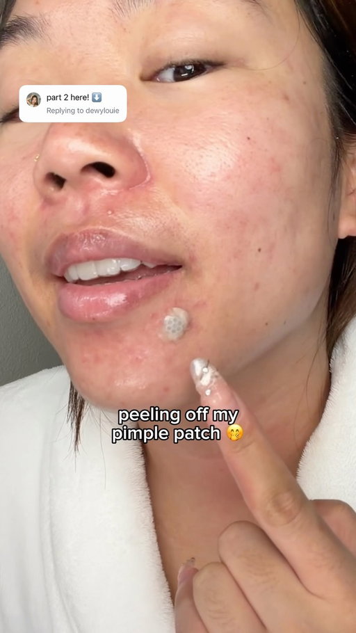 that was a 10/10 peel 🤩 #acne #skincare #pimplepatch  @easyderm.official