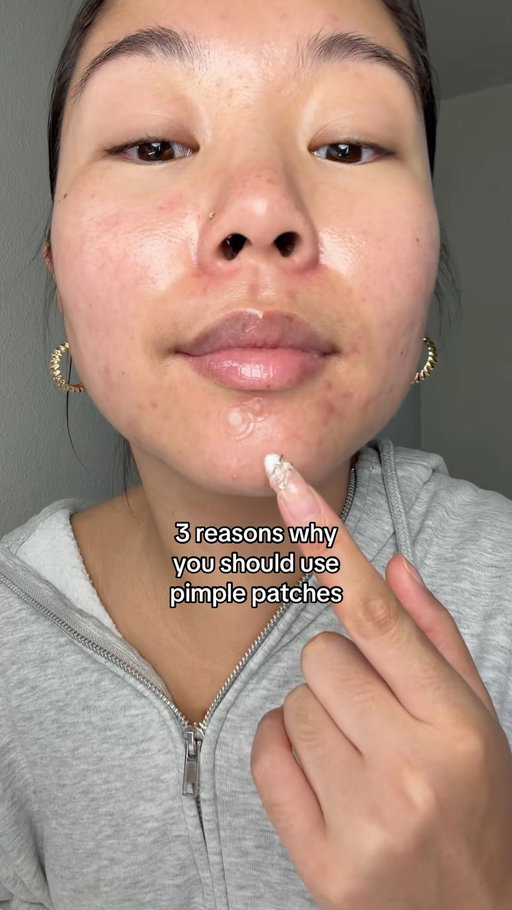 pimple patches > pimple popping 🙂‍↕️ #acne #skincare #pimplepatch