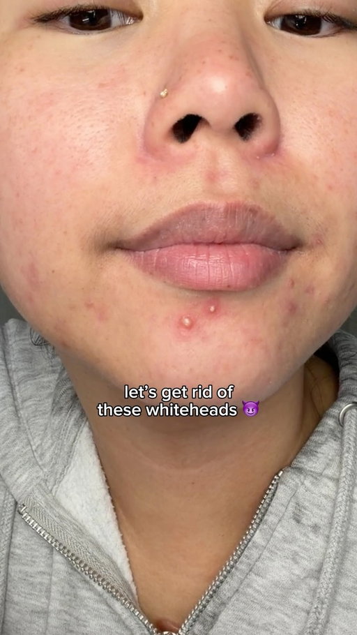 wow those were some juicy peels 🤩 @get_rael #acne #skincare #pimplepatch #acneskincare