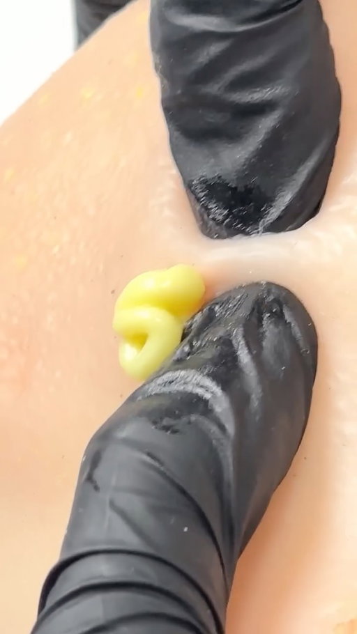 Anyone partial to a pimple-popping video? 🫪🤚

No judgement from us, this is a safe space. We know it can be tempting to pop a blemish. But while it may provide some immediate relief, it can actually cause more damage; increasing the risk of scarring and dark marks. 

So, save the popping for the doll. Find your skin’s match at theordinary.com 🤍