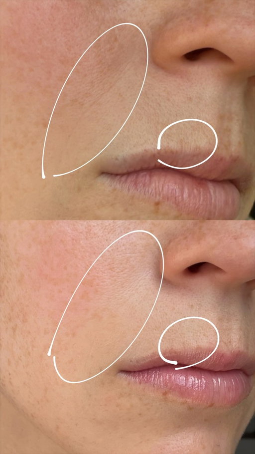 Résultats après environ 2 mois avec la Crème de nuit AlphaRet de @skinbettercanada :) C’est un savant mélange de rétinoide + acide glycolique qui m’a aidée à obtenir une peau plus lisse et surtout un teint éclatant ! Je vois mes ridules diminuées et mon grain de peau pefectionné. Le meilleur dans tout ça c’est que je n’ai eu aucune irritation, même si j’ai de la couperose sur mes joues. C’est un produit culte, un favori des dermatologues et des esthéticiennes… et maintenant de moi aussi ;) 

PS : ma bouteille n’est pas encore finie donc je vais poursuivre mon essai…!

#pub #AlphaRet #SkinBetter