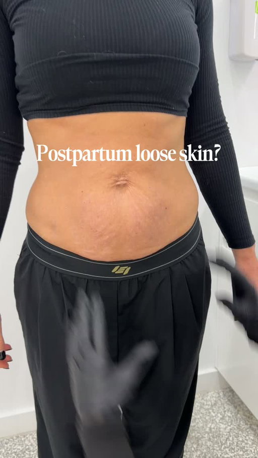 🚨 50% OFF HIFU Body skin tightening — right now! 🚨

After pregnancy, loose skin around the abdomen can feel impossible to shift no matter how clean your diet is or how hard you train 😔 That's because diet and exercise can't rebuild lost collagen. HIFU Body can. 💪

High-Intensity Focused Ultrasound (HIFU) delivers precise ultrasound energy deep into the skin's foundational layers, triggering your body's own collagen regeneration process from within ✨

✅ Targets loose, crepey skin at the source
✅ Stimulates natural collagen and elastin rebuilding
✅ Zero downtime — walk in, walk out 🚶‍♀️
✅ TGA-certified, medical-grade technology 🏥
✅ Results that continue to improve over weeks 📈

The same skin tightening technology trusted by 100,000+ clients across Australia 🇦🇺

No surgery. No recovery time. Just real, measurable results. 🙌

💥 For a limited time, HIFU Body skin tightening is 50% OFF — don't miss it!

✅ Book your free consultation via the link in our bio.

💳 Flexible payment options with Afterpay & Humm

📍 19 clinics across NSW, ACT, SA & QLD
📞 1300 10 10 55 

#hifubody #hifuskincare #skintightening #looseskin #postpartumskin #postpartumrecovery #mumtransformation #collagenboost #nonsurgicalskincare #bodycontouring #skinrejuvenation #australianskincare #bodyconfidence #skinlaxity