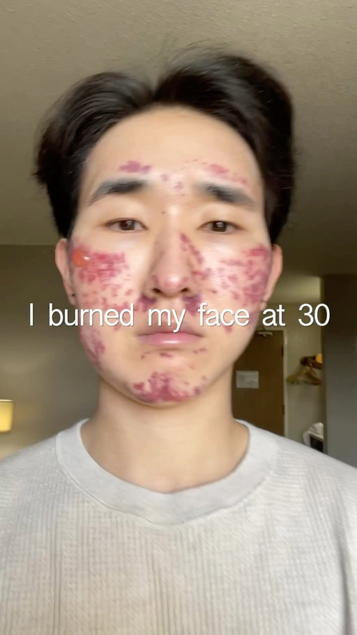 A couple of years ago I had a freak laser accident and it completely burned my face. The aftermath left me discolored, insecure and just a shell of a human person. From the kindness of the people around me I started regaining my confidence and bit by bit put my life back together. I just wanted to remind you (and myself sometimes) that even when the days feel impossible that it doesn’t last forever. You are strong, resilient, and oh so adaptable. Even though I wished that this wouldn’t have happened to me, it’s taught me so much about not wasting time professing your feelings, enjoying time in the present, and how important it is to take care of yourself.

Audio is from @/writers.cramp on tiktok 🤍