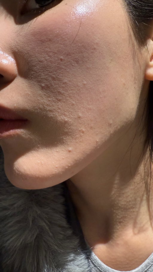 How to get rid of closed comedones without damaging your skin: exfoliate properly with gentle chemical exfoliants + don’t skip barrier care

Product mentioned: Unleashia 2-step zero pore overnight bubble Mask

Get 15% off on YesStyle with exclusive code!
UNLEASHIABUBBLEMASK15AA
Valid: Aug 27 – Oct 31

#koreanskincare #skintok #exfoliation #closedcomedones #cloggedpores