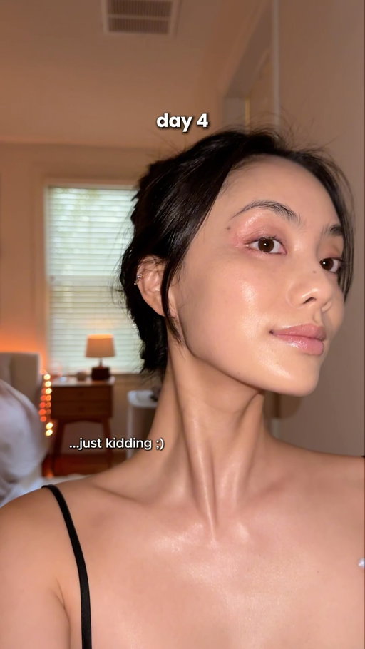 the glow is unreal!! the PIH/PIE from breakouts look better than they have in months, skin texture is improved, and the skin is feeling glassyyy af 🪞

microneedling is one of my favorite easy procedures to get when you have little downtime and just want a quick refresh. it’s by no means a miracle worker if you have deeper pathology that you’re trying to correct (eg, chronic hyperpigmentation, deep acne scarring, fine lines that have been etched in), but works for all skin tones and skin types ❤️ 

I personally do a session quarterly because the healing is just so quick and easy, and ya girl just loves a lil maintenance ✨ 

leave any questions 👇🏼
