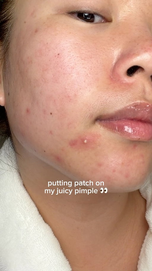 obsessed with the azaleic acid duo from @torriden for my acne-prone skin 💚 get it with the 🔗 in my bio! #TorridenPartner #Azelaicacid #Acne #Acnescars #redness