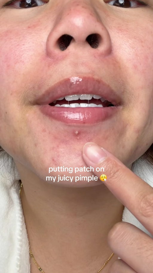 im always breaking out on my chin 😭 #pimplepatch #acne #skincare #acneskincare @easyderm_global @easyderm.official @skinfix @realeactives @purito_official @eadem.co