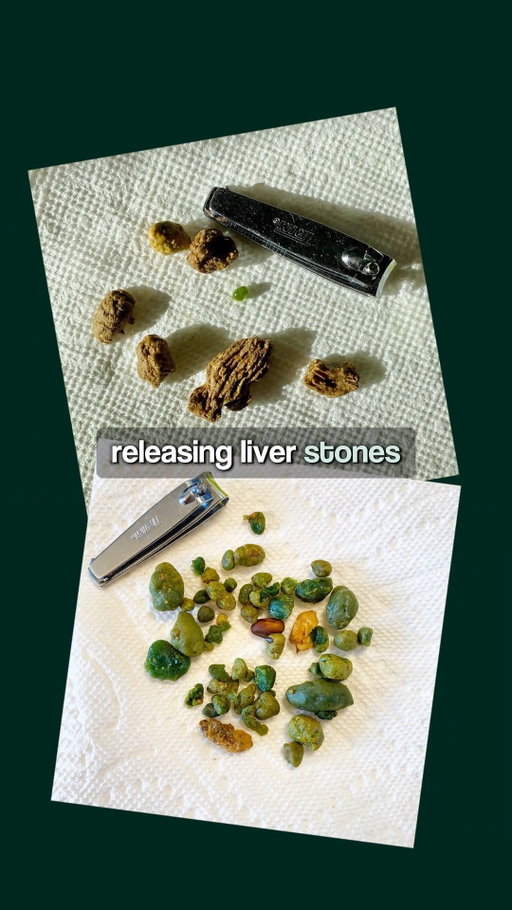 GOLF BALL-SIZED gallstones… from drinking AYAHUASCA? 😳

Josh Macin recalls witnessing a holistic psychiatrist pass what appeared to be large stones during an ayahuasca experience, without using a traditional liver-flush mixture.

He also describes experimenting with olive oil, food, and fiber to understand how similar green formations might develop.

But the appearance of these formations doesn't confirm they're gallstones, and there's no reliable evidence that ayahuasca removes gallstones from the body.

#JoshMacin #DetoxDudes #Ayahuasca #Gallstones #GutHealth