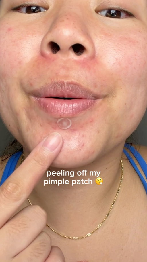 im so surprised this patch didnt fall off 😏 #pimplepatch #acne #skincare #acneskincare @easyderm.official