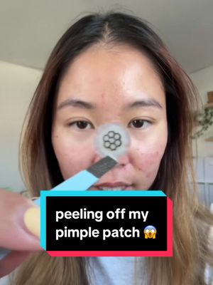 Replying to @✰ carsonnnn 🐣 💜 not the whitehead doing a handstand lol 🤸 #acne #pimplepatch #skincare @Easyderm 