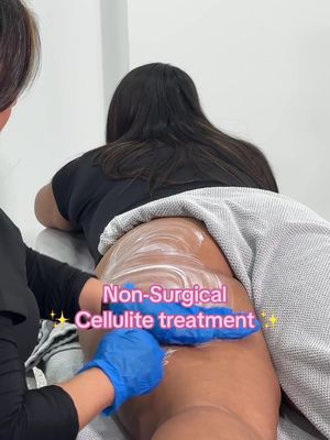 Cellulite appears when fat cells below the surface of the skin swell, giving it a dimpled and lumpy appearance.  This build up of stubborn fat, combined with loss of elasticity of the skin can be extremely difficult to remove, and depending on the severity, may require a combination of different technologies and a multi-step cellulite treatment approach over a period of time. #cellulite #cellulitereduction 