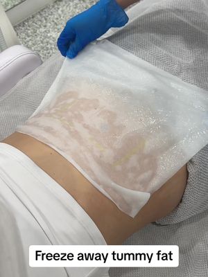 Fat freezing, or cryolipolysis, works by using controlled cooling to target and destroy fat cells, a process that causes them to crystallize and die through natural cell death. The targeted fat cells are then gradually eliminated from the body over several weeks and months via the natural lymphatic system.  The procedure is non-invasive, selectively targeting subcutaneous fat without harming surrounding tissues, muscles, or blood vessels. #fatfreezing #bodygoals #sydney 