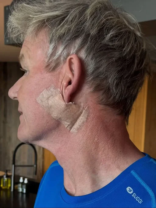 And their fast reactive work on removing this Basal Cell Carcinoma thank you ! Please don’t forget your sunscreen this weekend ❤️I promise you it’s not a face lift! I’d need a refund…….😜