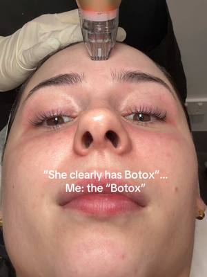 Not Botox girl but this is definitely more beneficial in the long run! Sylfirm X, the only dual-wave RF microneedling device that delivers faster, noticeable results with minimal discomfort & downtime. With pulsed & continuous RF technology, it effectively treats pigmentation, skin tightening, rosacea, scarring, pores & fine lines, all in one device! This is my 3rd treatment & im already noticing all the promised results! 📍 Silk Laser Clinic Double Day  This is a gifted experience ( I have also paid for this before xx )