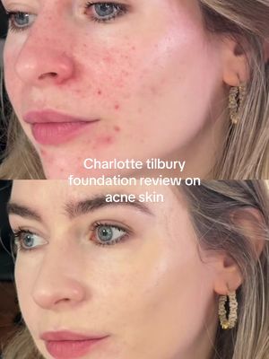 Trying the new @Charlotte Tilbury airbrush flawless matte foundation on my acne skin #acneproneskin #foundationreview #charlottetilburymakeup 