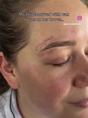 As a human your first thought is… holy fuck ouch. But as a MUA your first thought is… this is manageable. This is why you hire an experienced MUA for your big day: you never know what can happen the week leading up to your wedding.  The biggest issue with burn covers is trying to conceal and match the texture of the burn AND without it looking too product heavy. I approached this with thin hydrating layers of color corrector, concealer and powders that went beyond the actual burn to trick the eye into thinking it’s not even there!  Layer 1: moisturizer  Layer 2: green color corrector  Layer 3: powder Layer 4: concealer  Layer 5: powder  Layer 6: concealer  Layer 7: powder  Layer 8: powder foundation  Can you even tell?  #makeupartist #makeup #mua #makeuptutorial #destinationmakeup                        