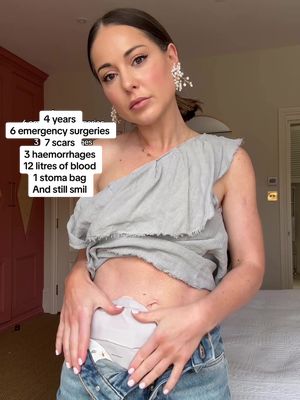 4 years  6 emergency surgeries 7 scars 3 haemorrhages  12 litres of blood 1 stoma bag And still smiling Because I’ve got 1 beautiful baby Also still smiling because I’m still here. Feeling like a cat with 9 lives. #stoma #ibd #birthtrauma #ulcerativecolitis #autoimmunedisease 