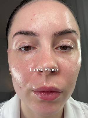 Luteal Phase Vs menstruation Vs Follicular Phase Vs Ovulation.  I found myself having a few more spots than normal in my ovulation phase! I love seeing the differences on how our hormones play a massive role in our skin!