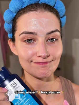 Over hydrating the skin + summer heat can lead to a rash the internet has nicknamed fungal acne. I know that’s not the technical name but if your forehead suddenly erupts like this, you may have the same issue. Some nizoral shampoo + gel moisturizers should clear it in a few days. #skincarefail #fungalacne #skincare 
