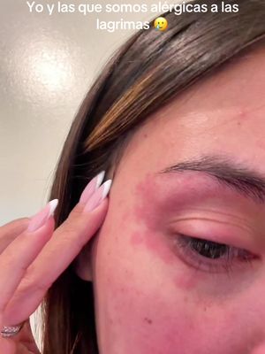 Conocían a alguien alérgica por las lagrimas también? 🥲 #alergias #face #rostro 