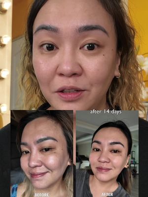 SKL I have been using Dr Leo 377 Whitening Set para mas mabilis maglighten ang mga blemishes. I LOVE IT! Lightweight lang din sya kaya pwede under makeup. #drleo #darkspot #acnescar #whiteningcream #skincare 