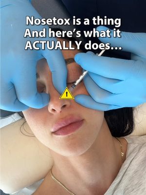 If you’re looking to get any neurotoxin done and in Montreal, I’ve been going to @Dermafina for 8+ years now  . Just giving you some realistic and honest feedback on nosetox. I personally did Dysport but as much as I prefer Dysport for my forehead, I feel like I’ve gotten better results with this procedure with Botox in the past (likely because it spreads less). I will ask for Botox next time. Hope this helps ! #botox #dysport #nosetox #medicalesthetics  . Botox, Dysport, nosetox, non surgical nose job, medical aesthetics, Montreal