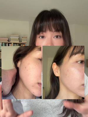 7 days is impressive for my face which seems to be perpetually red otherwise @SKIN1004 US #skin1004partner  #skincareroutine #centella #skin1004 #koreanskincare