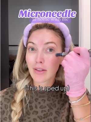 Microneedle at home with me. I’ve been doing this since I was 20 🤝🏼