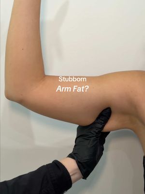 Fat Freezing is our go-to treatment for those stubborn pockets ❄️🖤