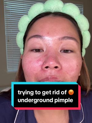 trying to get rid of my underground pimple in 24 hours 🥲 #pimplepatch #acne #skincare @Tower 28 Beauty @Murad Skincare @Easyderm 