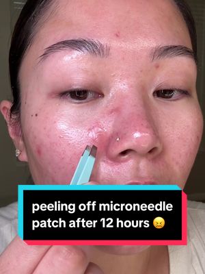 Replying to @lee 🍸🐈‍⬛🌙 peeling off microneedle pimple patch after 12 hours 😖 #pimplepatch #acne #skincare @Tower 28 Beauty @Murad Skincare @Easyderm 