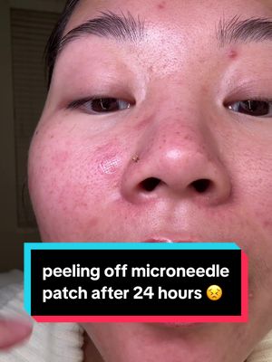 Replying to @jasmine | sahm & army wife peeling off microneedle pimple patch no. 2 😣 #acne #skincare #pimplepatch @Tower 28 Beauty @Easyderm @Sofie Pavitt Face 