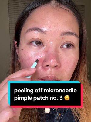 Replying to @Kristyna peeling off microneedle patch no. 3 😩 #acne #pimplepatch #skincare @Easyderm @Tower 28 Beauty @Neutrogena @Sofie Pavitt Face @SOME BY MI US @PURITO SEOUL @Olehenriksen 