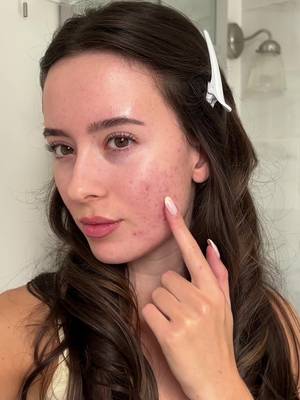 White head before bed? We know the feeling... 😴 Check out our Purifide Skin Restore Power Patches to absorb white heads, reduce redness and resurface + restore skin 💜