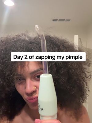 DAY 2! I think this pimple should be gone by day 3. I have the zapper and microneedle pimple patch on my LTK