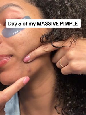 Day 5 of my massive pimple. Unfortunately I don’t have my zapper so I’m stuck with now only having 1 more pimple patch on this trip 