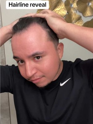 Getting that hair transplant surgery in Turkey @Turkey hair transplant clinic #fyp #hairtransplant #hairtransformation 
