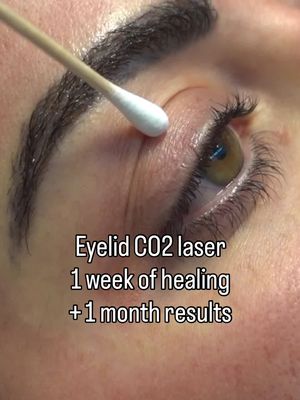 This was over 4 years ago ! And I definitely am due to do this again especially for my upper lids. Eyelid CO2 is undoubtedly on my 2026 bingo card. This helps contract the skin in the area and blast away a lot of crepeyness and fine lines. Often done on those not ready for eyelid surgery and surgeons even often use it in combination with surgery to improve the skin quality. The dead of winter is the best time to do it. I’d anticipate a solid 1 week for initial healing.  I did it @dermafina. I felt most comfortable with dr Krasny with him being a dermatologist. He will also inject you so ou won’t feel a thing !  . . #co2laser 