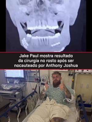 QUE DOR! 😳😬 Jake Paul publicou em suas redes sociais o raio-X do pós-cirúrgico mostrando como ficou seu rosto após ser nocauteado por Anthony Joshua. Segundo ele, a cirurgia na mandíbula foi um sucesso, mas lamentou “a perda de alguns dentes”. 📹: Instagram/jakepaul #ESPNKnockOut #JakePaul #AnthonyJoshua #tiktokesportes