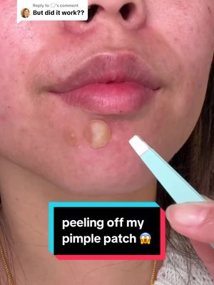 Replying to @🗯️ yes this pimple patch worked so well 😌 #acne #pimplepatch #skincare #acneskincare @Neutrogena 